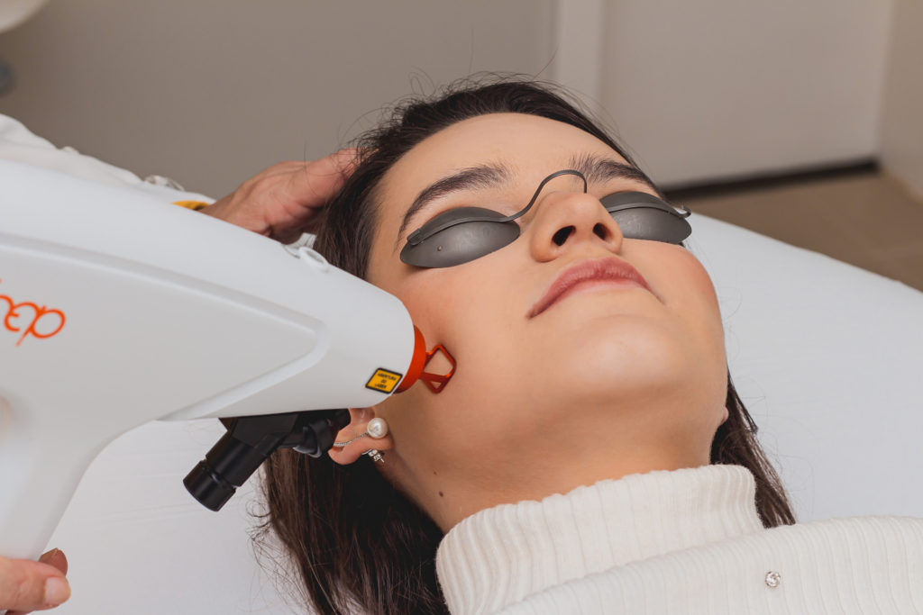 Laser ProDeep - para Mancha e Rejuvenescimento